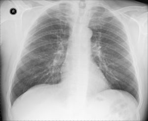 Hifoo Chest XRAY